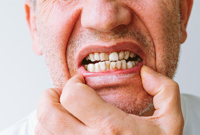 uomo mostra denti rovinati dal fumo
